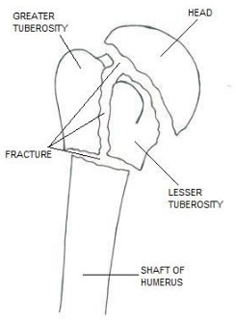 Proximal Humerus Fracture