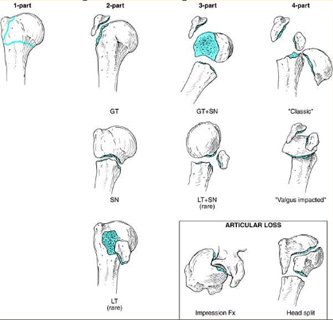 Proximal Humerus Fracture