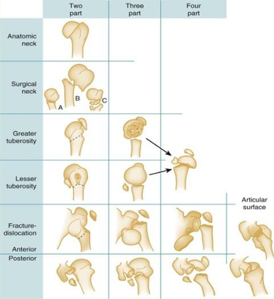 Proximal Humerus Fractures