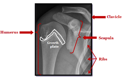 Proximal humerus growth plate in 13 yr old