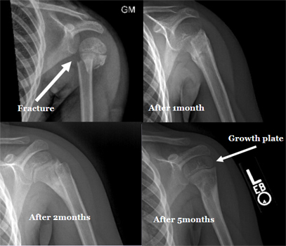 proximal humerus fracture in a 6-yr old