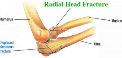 Radial Head Fracture