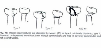 Radial Head Fracture