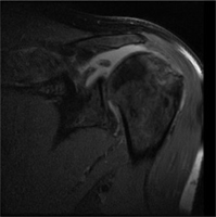 Reverse Prosthesis