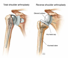 Reverse shoulder replacement
