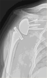 reverse total shoulder arthroplasty