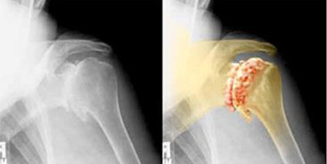 Rheumatoid Arthritis