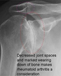 Rheumatoid Arthritis and other inflammatory conditions