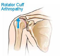 Rotator Cuff Arthropathy