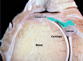 Rotator Cuff Tear
