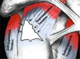 Rotator Cuff Tear