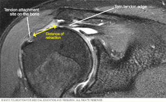 Rotator Cuff Tear