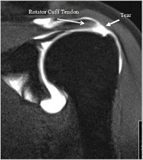 Rotator Cuff Tendon