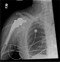 Humerus Treatments