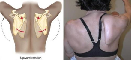 PEC major for Scapular Winging