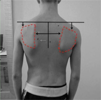 Scapulothoracic Dyskinesis