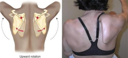 Scapulothoracic Winging