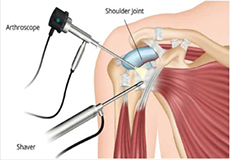 Shoulder Arthroscopy