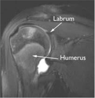 Diagnosis of Shoulder Instability