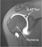 Diagnosis of Shoulder Instability