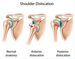 Shoulder Dislocation