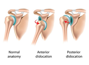 Shoulder Disloaction