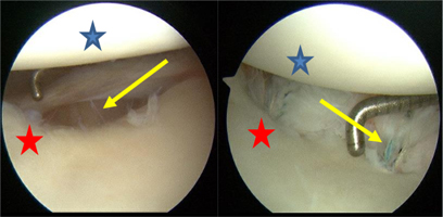 Arthroscopic surgery