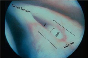 Superior Labrum Anterior and Posterior (SLAP) Tears