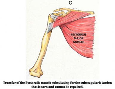 Tendon Transfer for Irreparable Subscapularis Tendon Tear