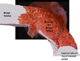 Tendonitis