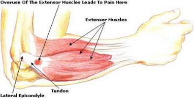 Tennis Elbow