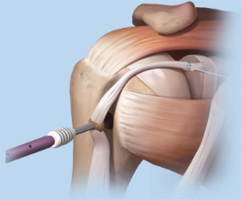 Tenodesis of the biceps