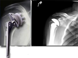 Total shoulder replacement