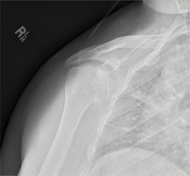 Total shoulder replacement