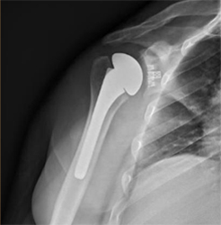 Total shoulder replacement