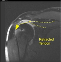 Lower Trapezial Transfer