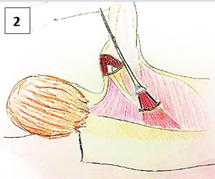 Lower Trapezial Transfer