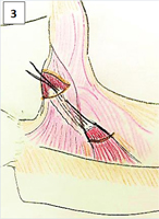 Lower Trapezial Transfer