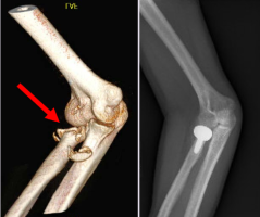 traumatic fracture and dislocation after realignment.