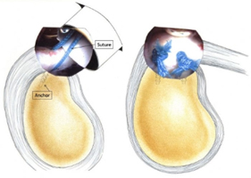 Treatment - Superior Labrum Anterior and Posterior (SLAP) Tears