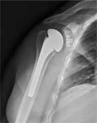 Total Shoulder Arthroplasty