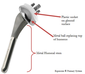 Total Shoulder Arthroplasty