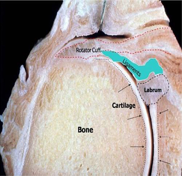 Rotar cuff tear