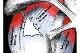 Rotator Cuff Tear