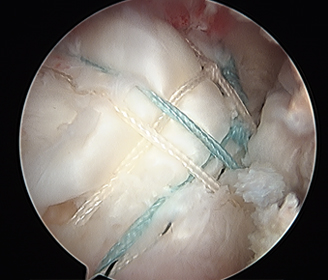 Rotator Cuff After treatment