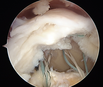 Rotator Cuff Before treatment