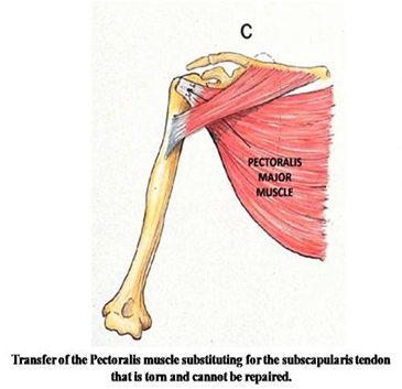 Tendon Transfer