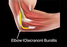 Elbow (Olecranon) Bursitis