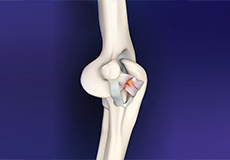 Elbow Ligament Reconstruction