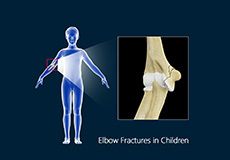 Elbow Fractures in Children